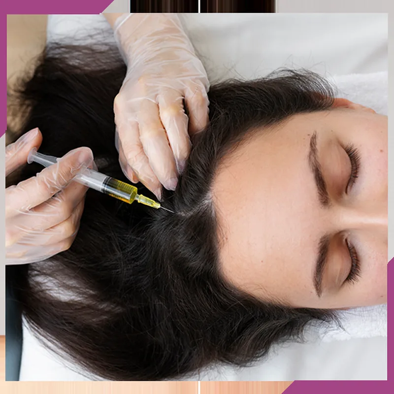 Keratin Destekli Saç Mezoterapisi
