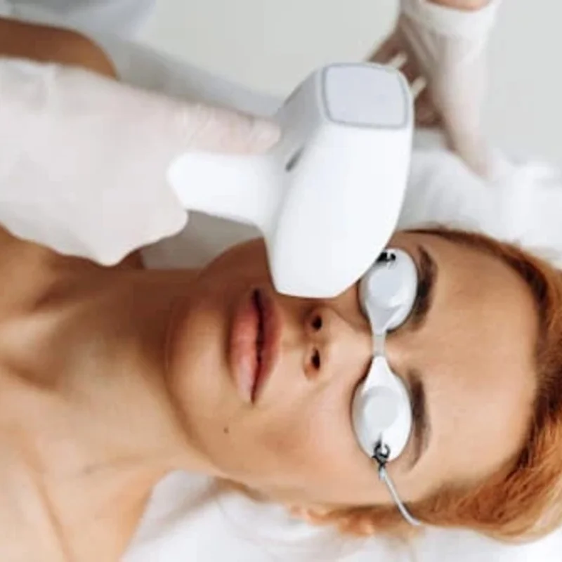 Yüz IPL Epilasyon