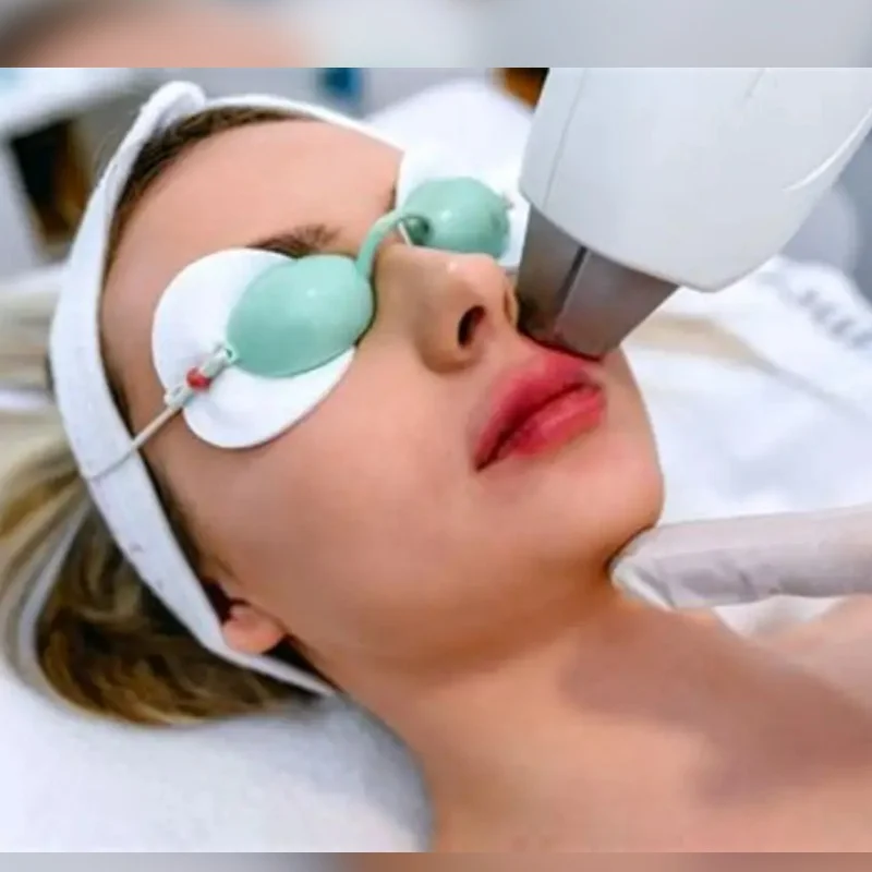 Yüz IPL Epilasyon