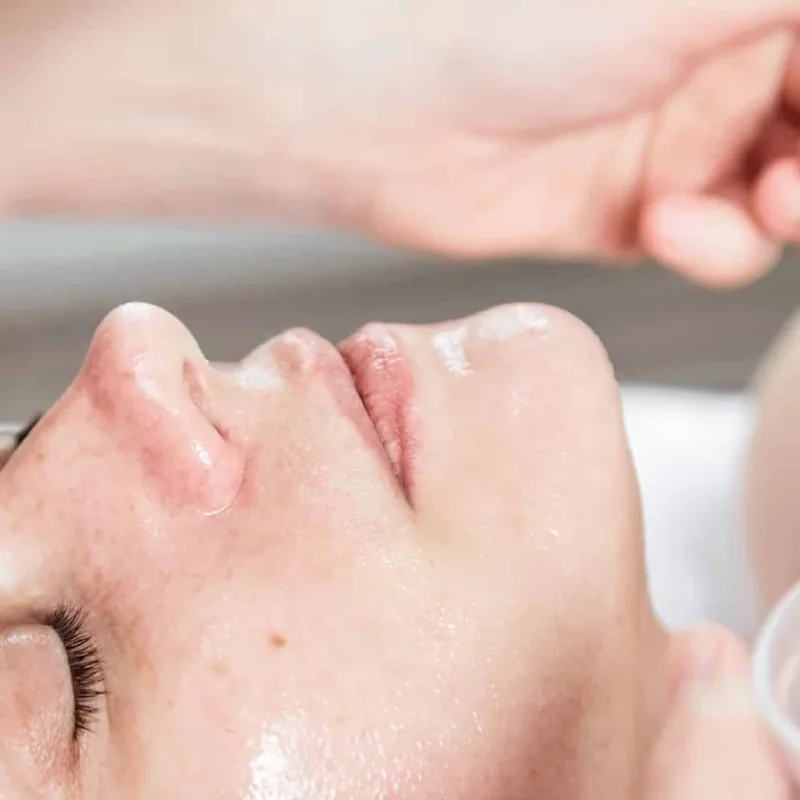 Laktik Asit Peeling