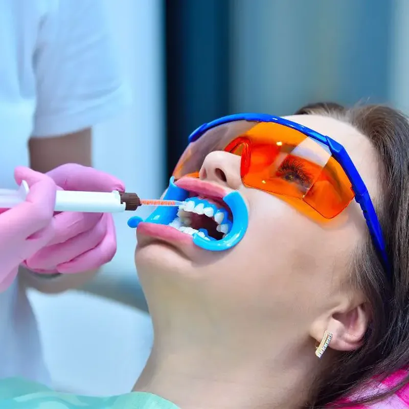 Klinik Beyazlatma Jeli Uygulaması